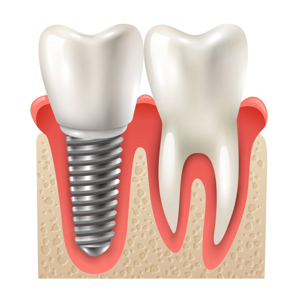 Are dental implants the future?