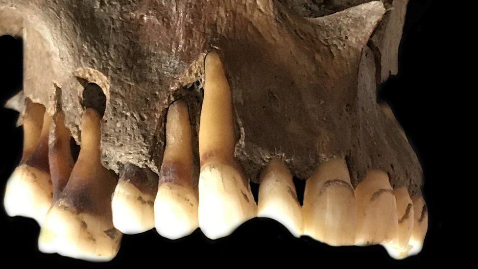A sample of ancient herpes DNA came from the teeth of a 17th century Dutch male